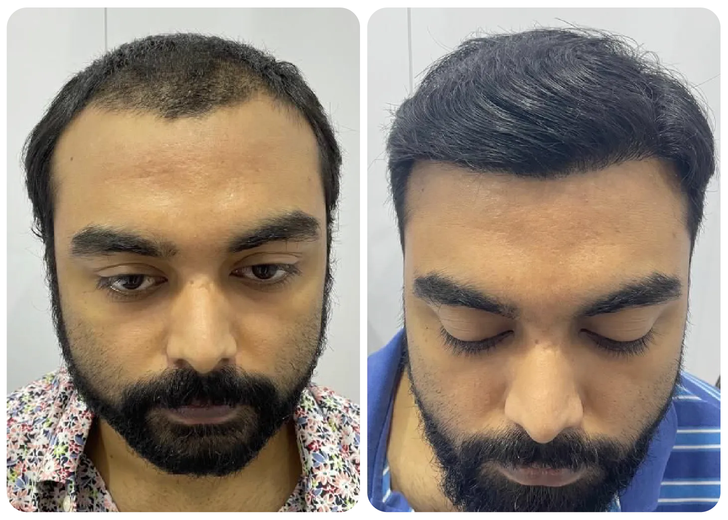 prp-hair-treatment-before-after-3